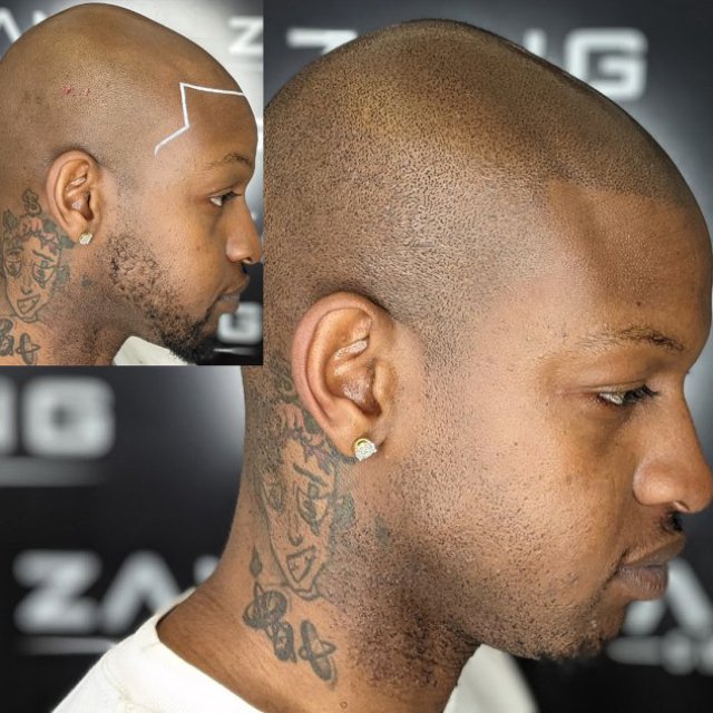 Zang SMP - Scalp Micropigmentation Orange County